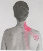 Spoušťové body –  trigger points